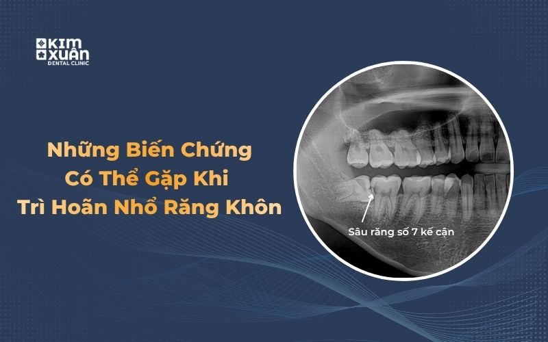 Những biến chứng thường gặp khi không nhổ răng khôn
