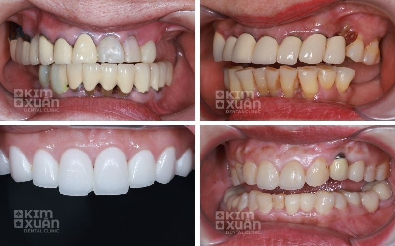 Những Dấu Hiệu Nhận Biết Nên Làm Răng Sứ Lại