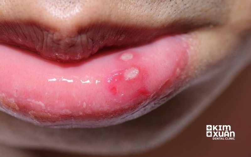 Những Dấu Hiệu Nhận Biết Viêm Lợi Ở Trẻ Em
