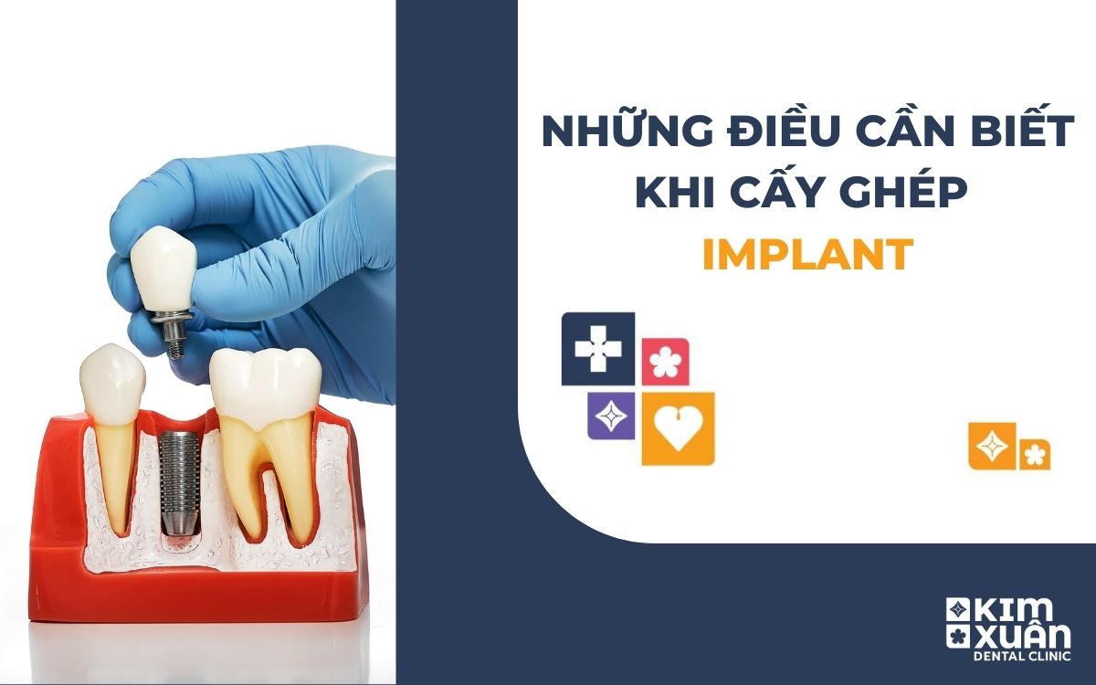 Những Điều Cần Biết Khi Cấy Ghép Implant