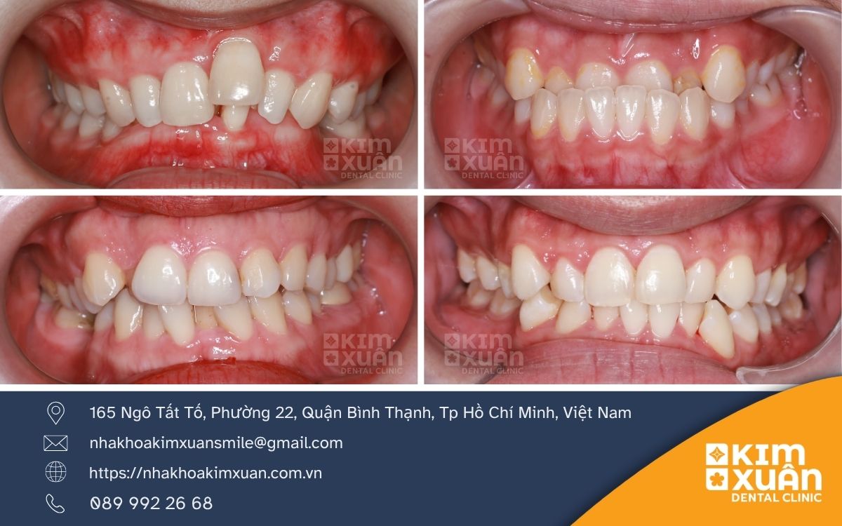 Những Điều Cần Biết Khi Chỉnh Nha