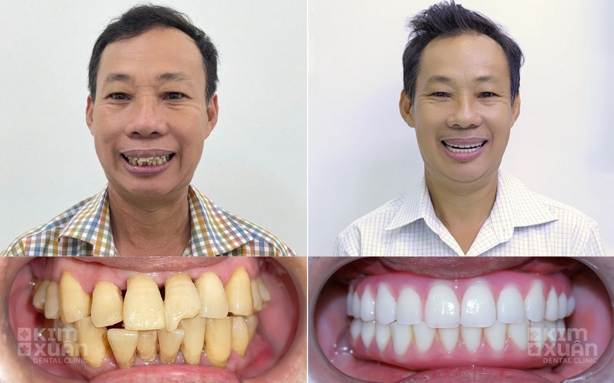 Những Lợi Ích Khi trồng Răng Cho Người Già