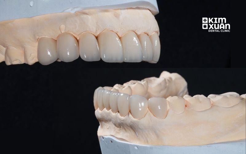 Những Lưu Ý Khi Dán Sứ Veneer Nguyên Hàm
