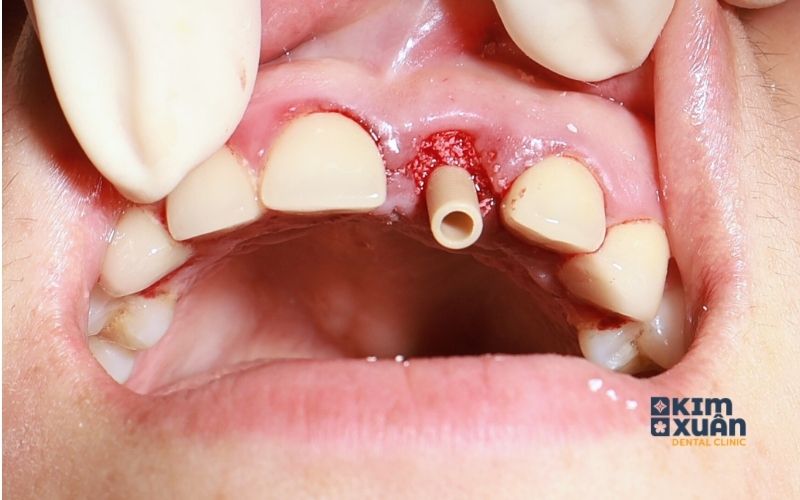 Những Lưu Ý Khi Ghép Xương Trồng Răng Implant