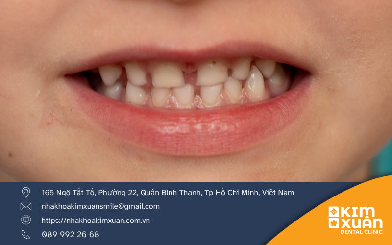 Những Lưu Ý Sau Khi Trám Răng Sữa