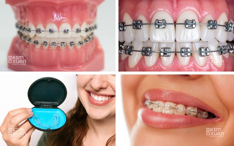 Những Phương Pháp Niềng Răng 2 Răng Cửa Phổ Biến Hiện Nay