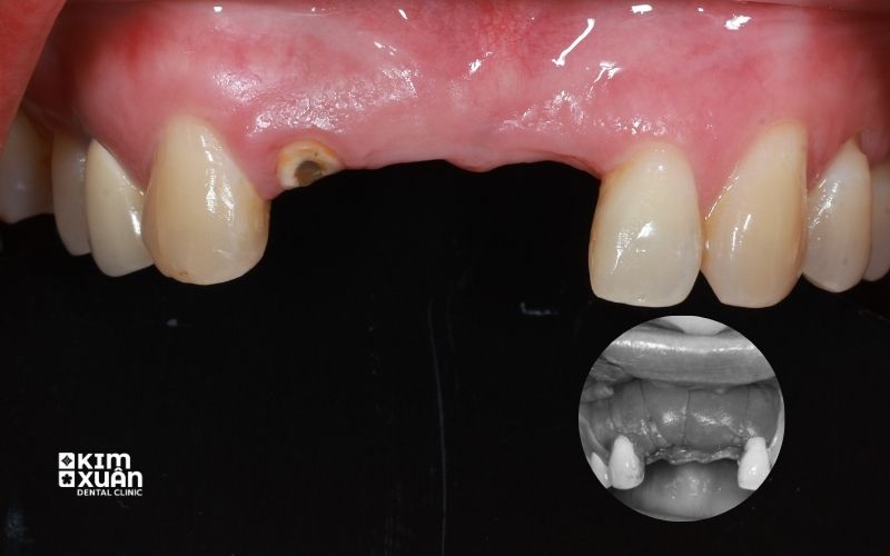 Những Truòng Hợp Nên Ghép Xương Răng