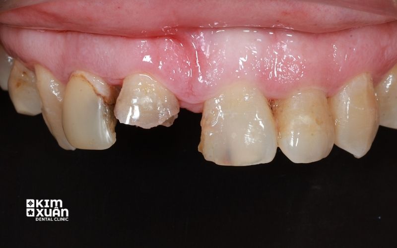 Những Truòng Hợp Nên Bọc Răng Sứ