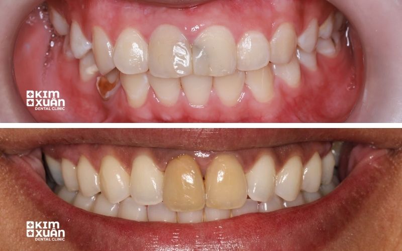 Những Trường Hợp Nên Bọc Sứ Răng Cửa