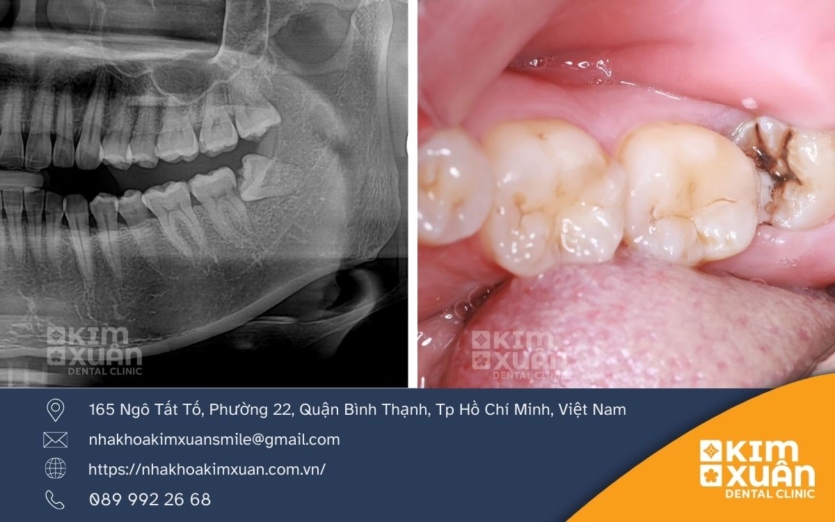 Những Trường Hợp Nên Nhổ Răng Khôn