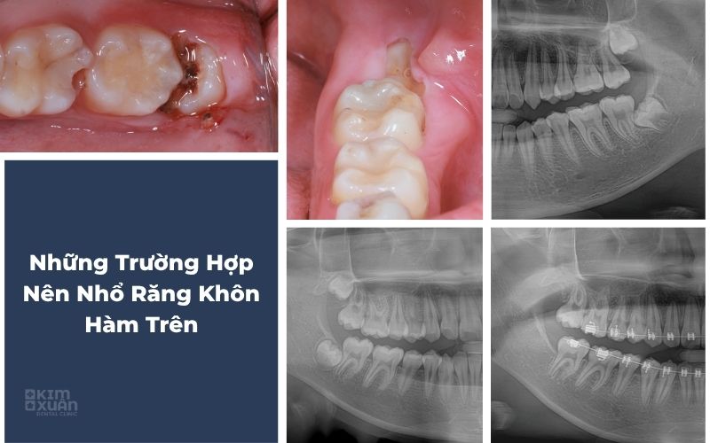 Những trường hợp nên nhổ răng khôn hàm trên