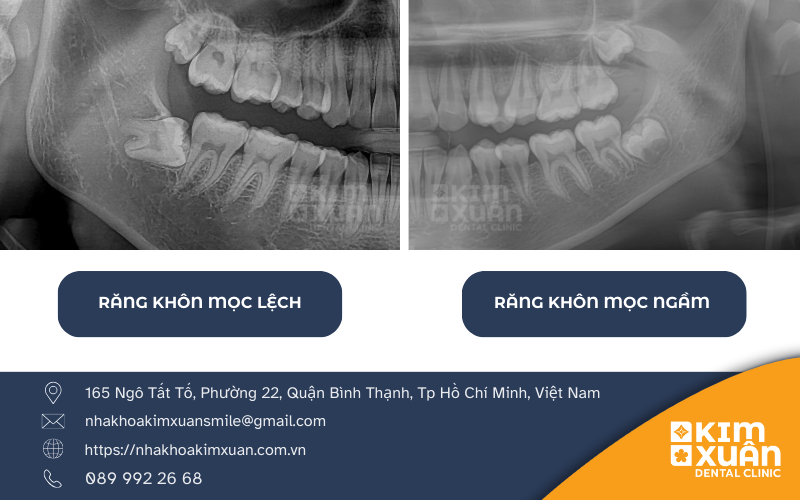 Những Trường Hợp Nên Nhổ Răng Khôn