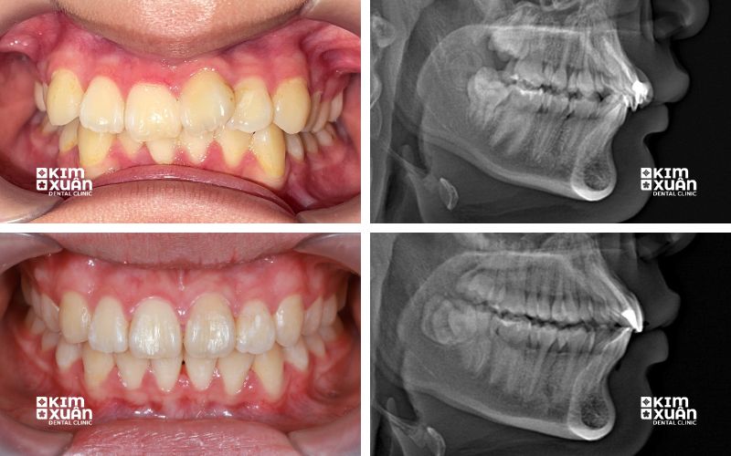 Trường hợp trẻ 15 tuổi nên niềng răng