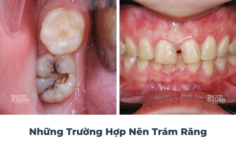 Những trường hợp nên trám răng phổ biến