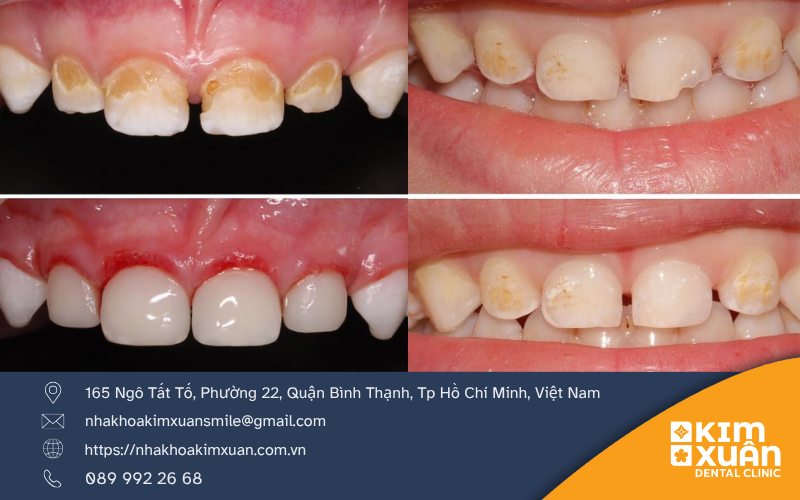 Những Trường Hợp Nên Trám Răng Sữa Cho Trẻ