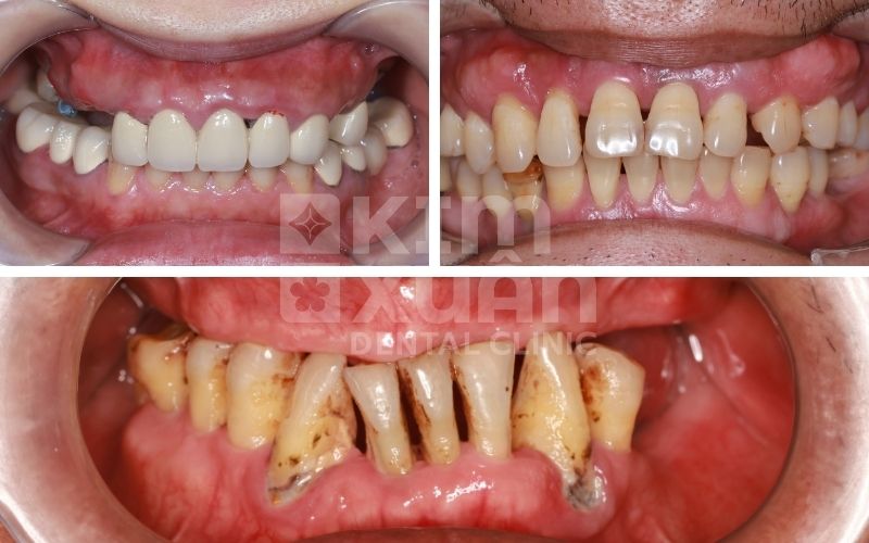 Những Trường Hợp Nên Trồng Implant All On 4