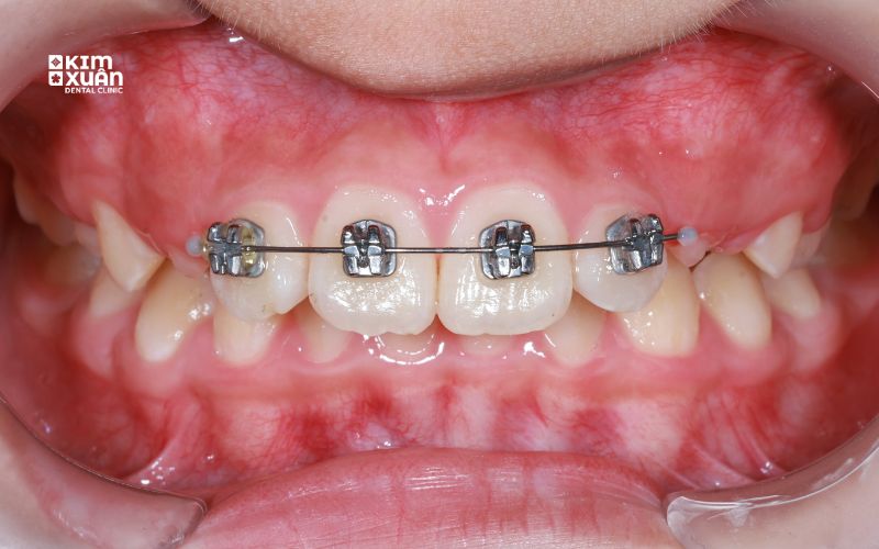 Những Trưòng Hợp Niềng 2 Răng Cửa