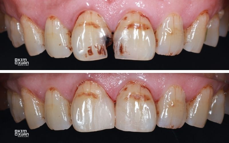 Những Trường Hợp Trám Răng Bị Đau Nhức