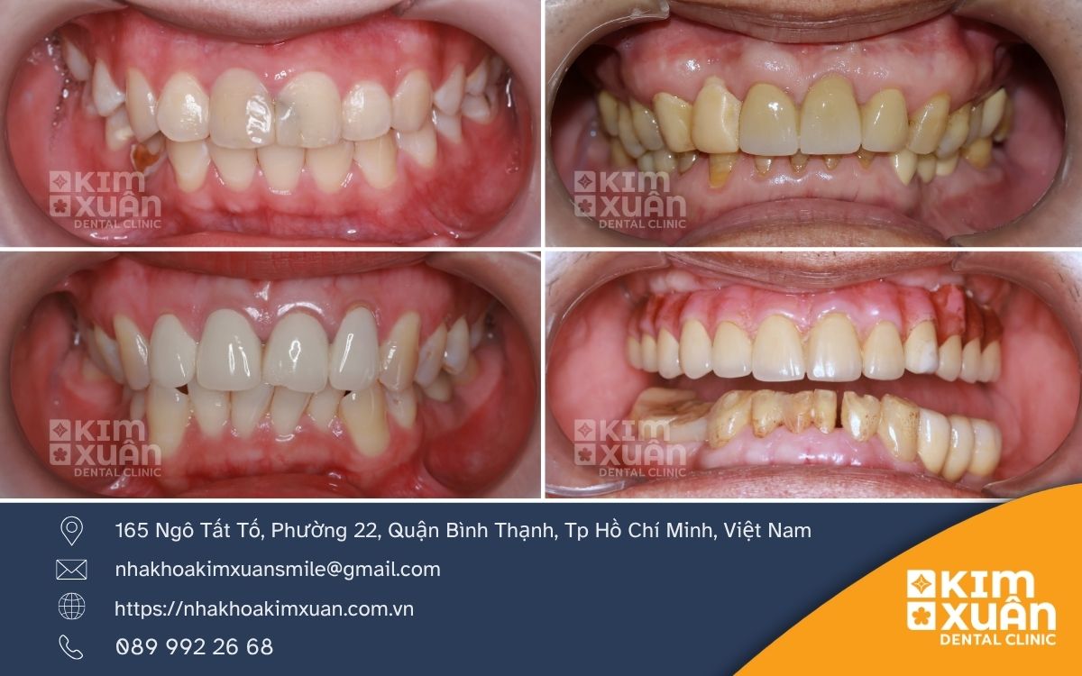 Những Trường Hợp Nên Bọc Răng Sứ