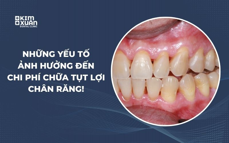 Những Yếu Tố Ảnh Hưởng Đến Chi Phí Chữa Tụt Lợi