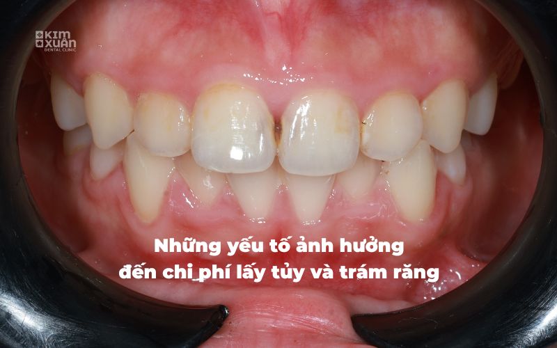 Những yếu tố ảnh hưởng đến chi phí trám răng lấy tủy