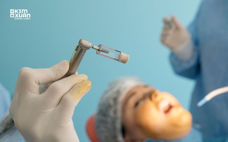 Những Yếu Tố Ảnh Hưởng Đến Thời Gian Trồng Răng Implant