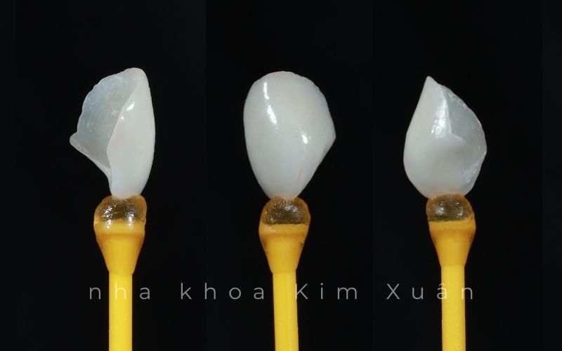 Nhược Điểm Của Mặt Dán Sứ Veneer