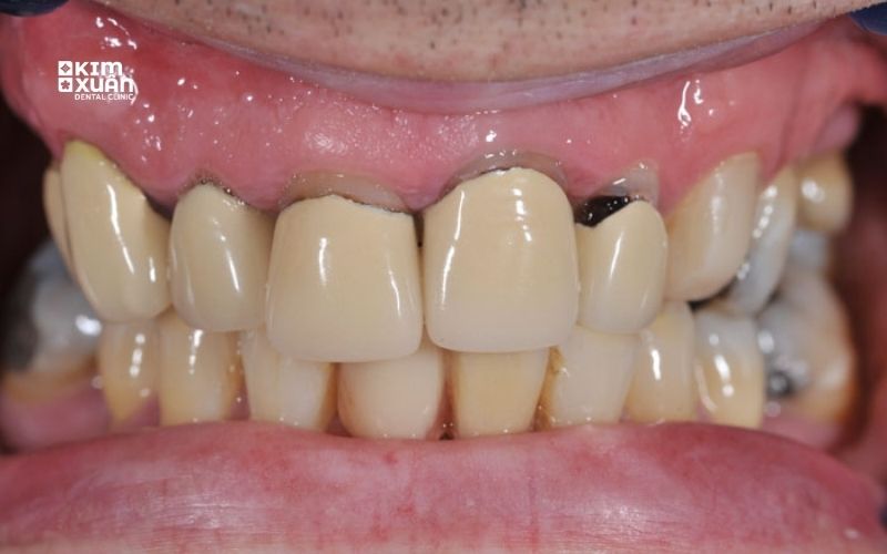 Nhược Điểm Của Răng Sứ Titan