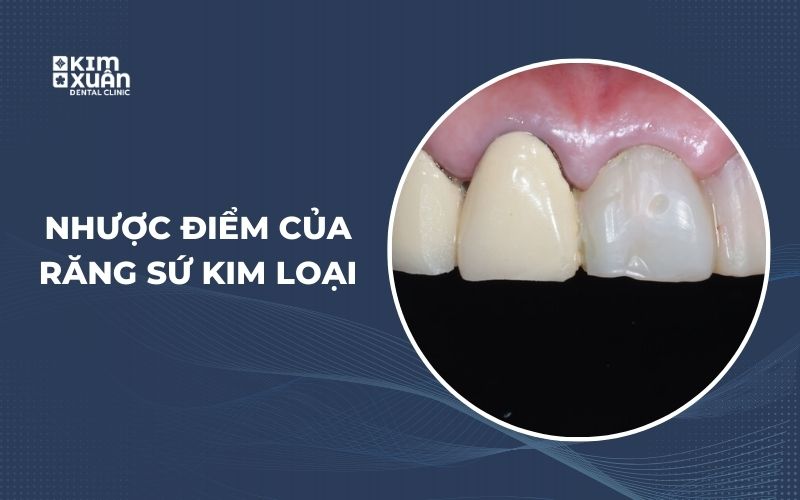Nhược Điểm Khi Bọc Răng Sứ Kim Loại