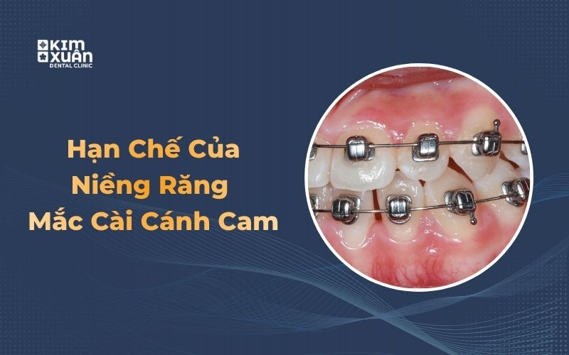 Nhược điểm khi niềng răng mắc cài cánh cam