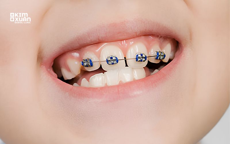 Niềng 2 Răng Cửa Có Được Không