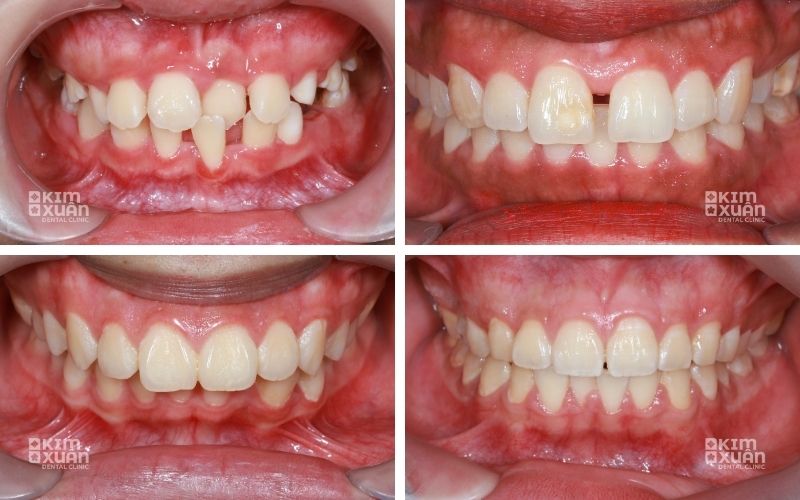 Niêng Răng 2 Răng Cửa Giá Bao Nhiêu Tiền