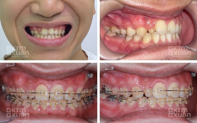 Niềng Răng Bị Móm Tại Nha Khoa Kim Xuân