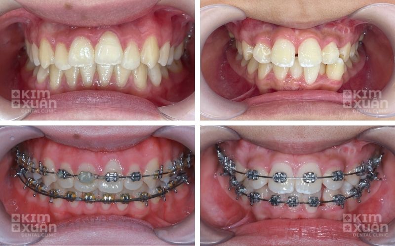 Niềng Răng Chỉnh Nha Cho Trẻ Răng Bị Mọc Lệch