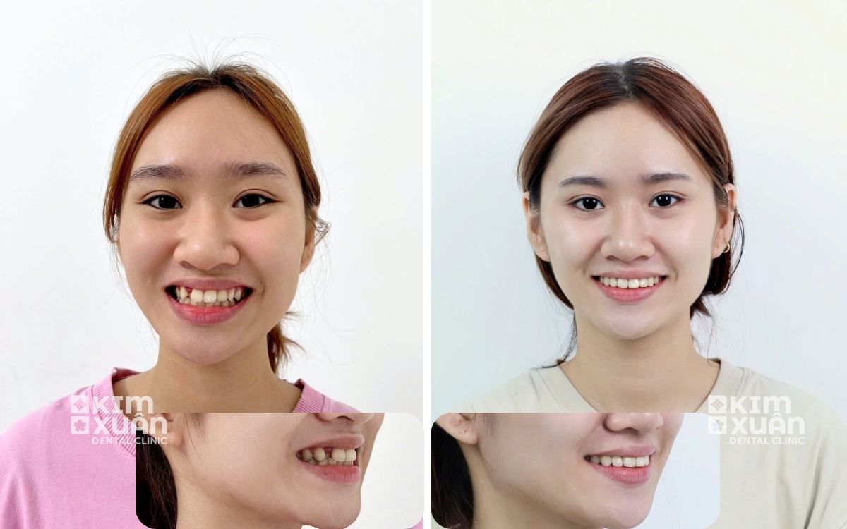 Niềng Răng Chỉnh Nha