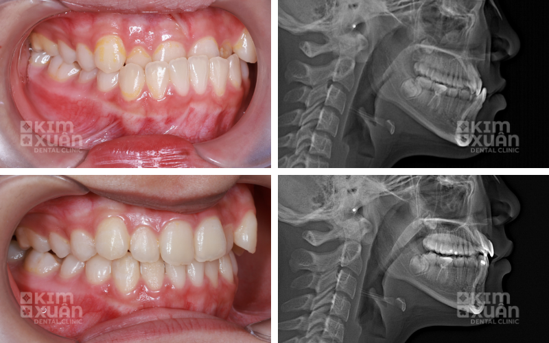 Chỉnh Nha Niềng Răng Nha Khoa Kim Xuân
