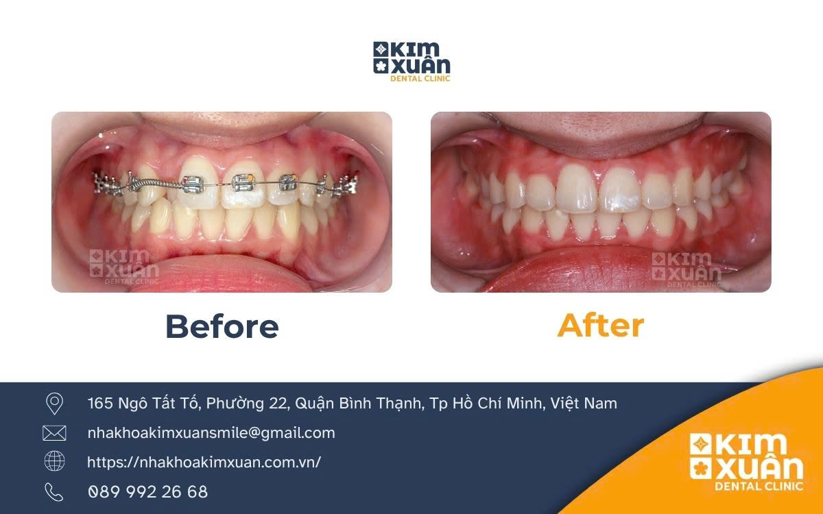 Niềng Răng Chỉnh Nha Ở Đâu Tốt Tại HCM Bình Thạnh