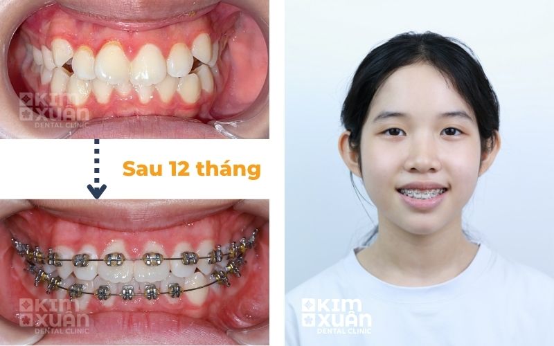 Niềng Răng Chỉnh Nha Trẻ Em Sau 12 Tháng Tại Nha Khoa Kim Xuân