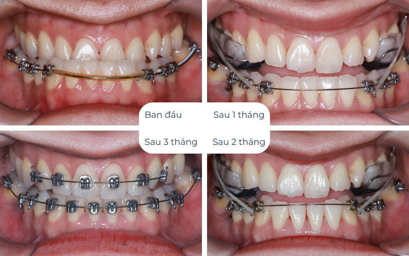 Niềng Răng Chỉnh Nha Uy Tín Tại Nha Khoa Kim Xuân