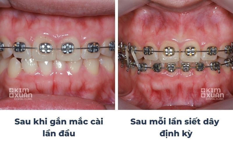 Niềng Răng Đau Nhất Khi Nào