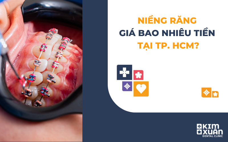 Niềng Răng Giá Bao Nhiêu