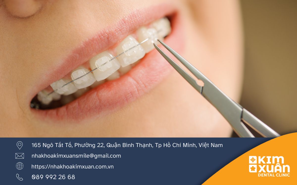 Niềng Răng Giá Bao Nhiêu