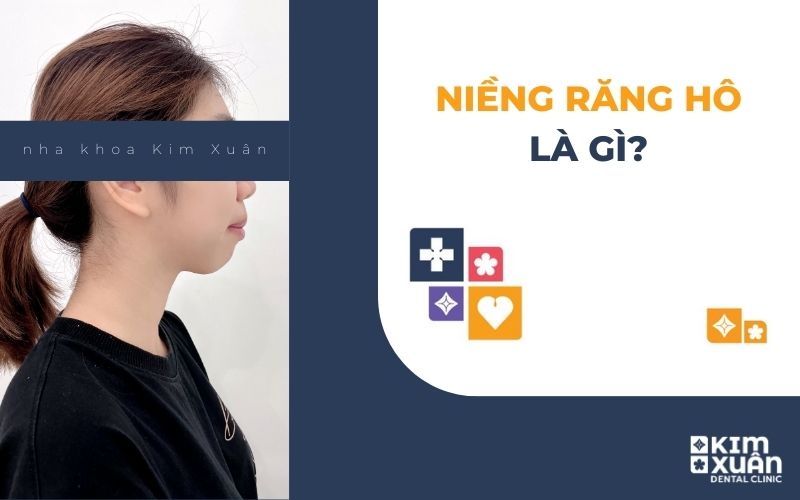 Niềng Răng Hô