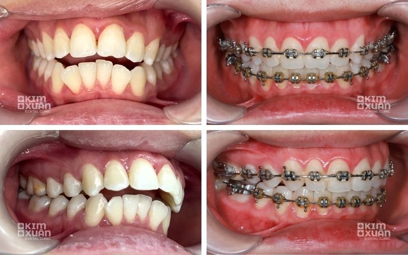 Niềng Răng Hô Bằng Mắc Cài Kim Loại