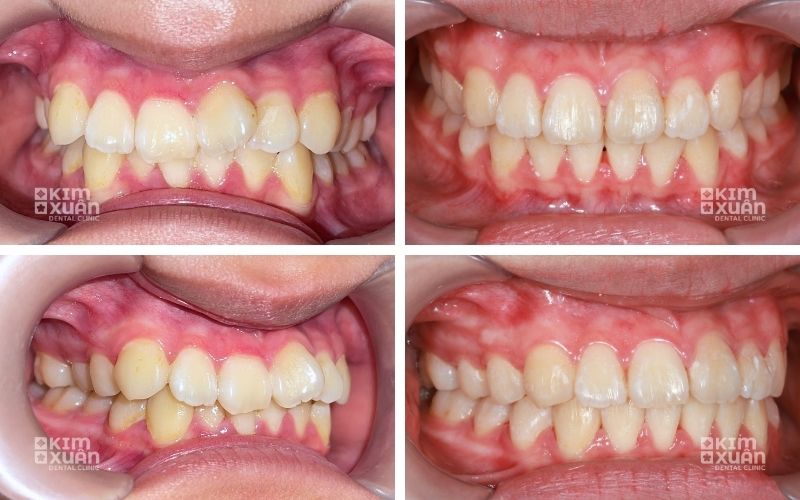 Niềng Răng Hô Bằng Máng Trong Suốt Invisalign