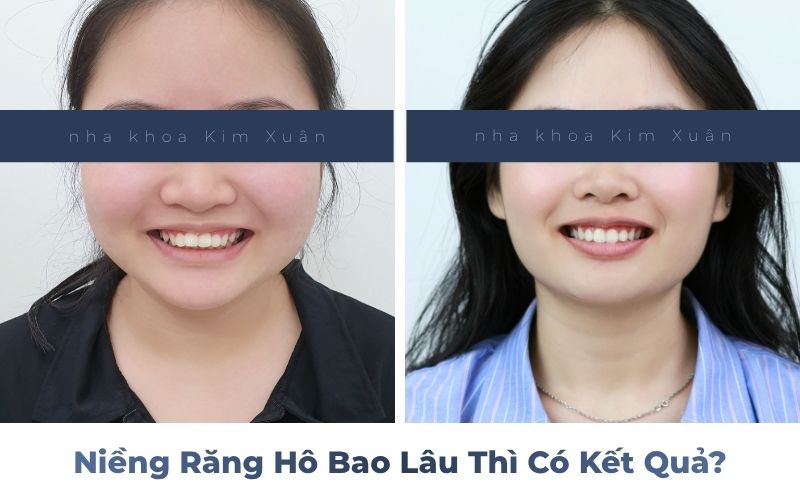 Hình ảnh trước và sau niềng răng hô cải thiện nụ cười