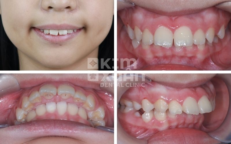 Hình ảnh răng hô, khấp khểnh ở trẻ em tại nha khoa