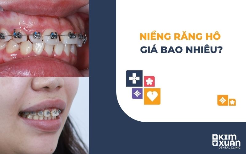 Niềng Răng Hô Giá Bao Nhiêu