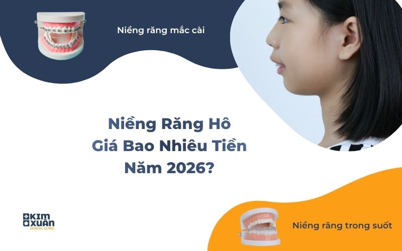 Chi phí niềng răng hô bằng mắc cài và khay trong suốt năm 2026