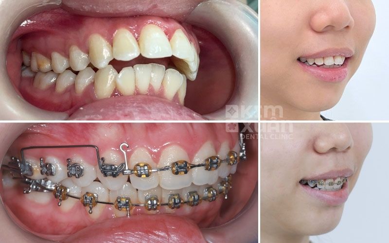 Niềng Răng Hô Mắc Cài Kim Loại Tại Nha Khoa Kim Xuân